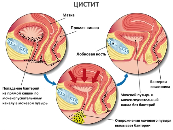 Мочевой пузырь и его заболевания