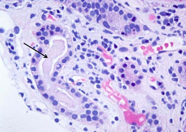 Следствием чего, в урине появляются следы лейкоцитарной эстеразы?