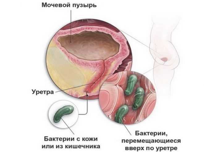 mochevyvodyashhie-puti-infektsii-e1499361899453.jpg