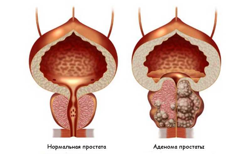 adenoma-prostaty.jpg