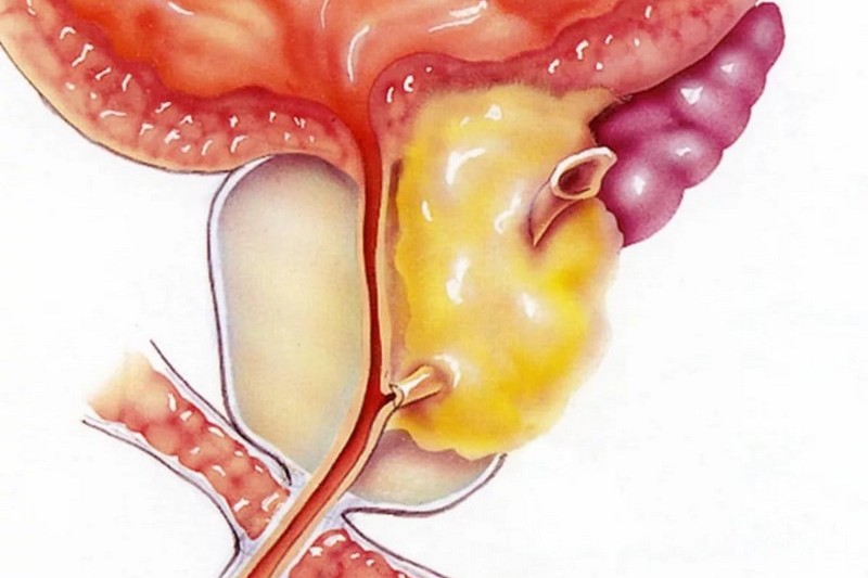 простатит воспаление предстательной железы