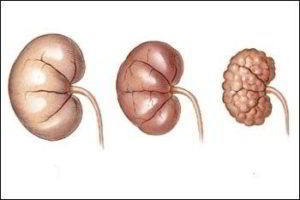 Хроническая почечная недостаточность