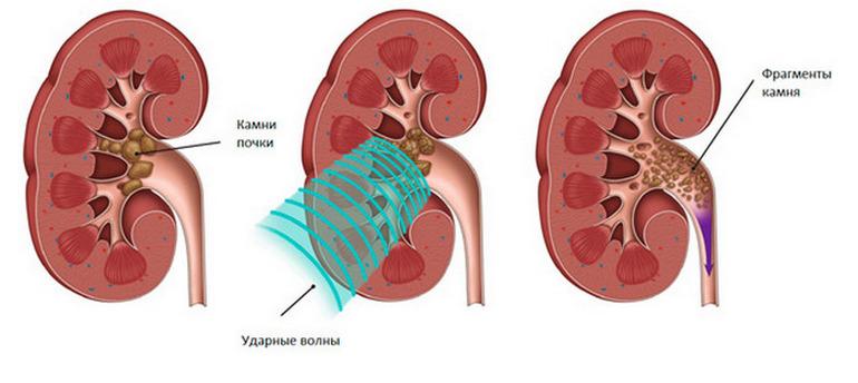 Процедура литотрипсии