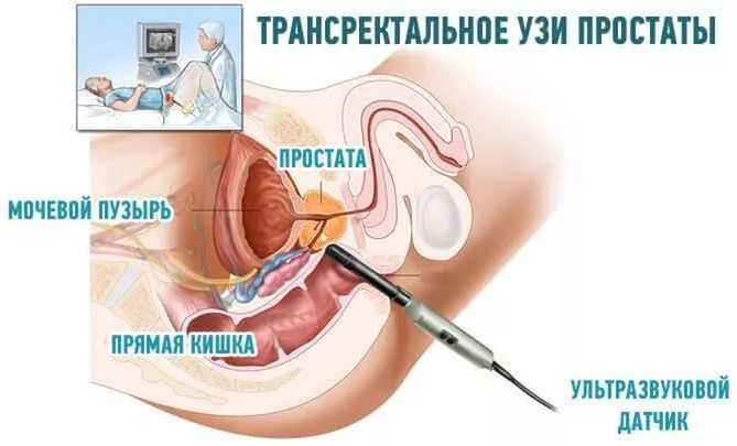transrektalnoe-uzi-prostaty.jpg