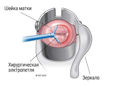 схема проведения процедуры