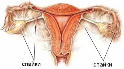 как выглядят спайки