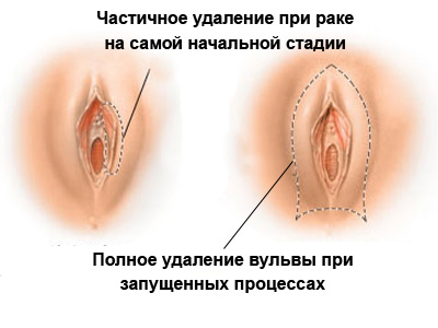 схема удаления вульвы при кератозе