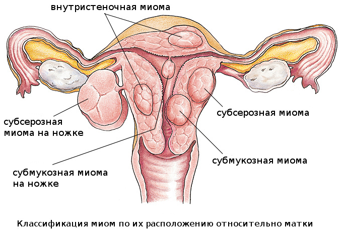 классификация видов миом