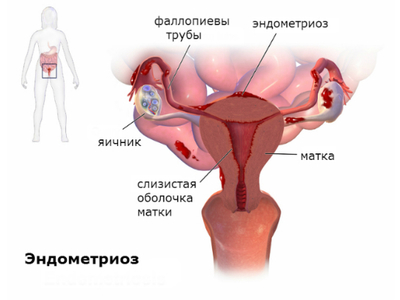 схема заболевания