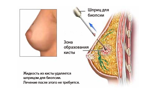 как делают биопсию