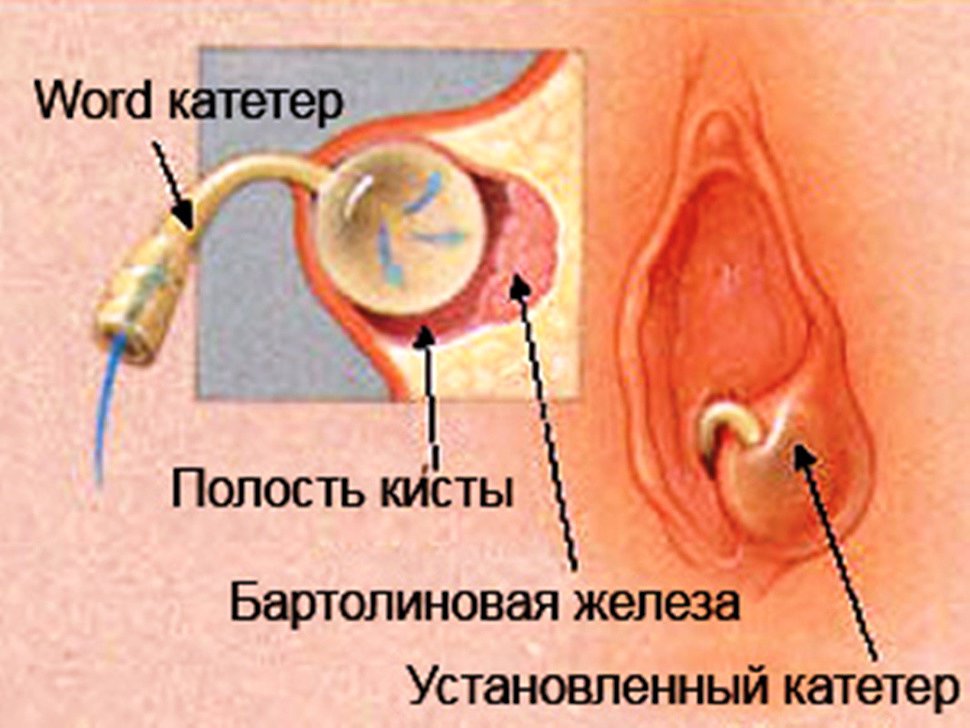 удаление с помощью катетера