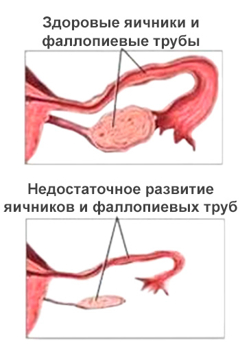 гипоплазия яичников
