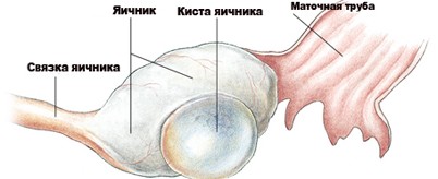 внешний вид кисты