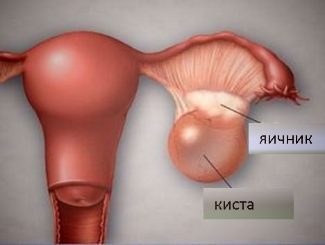 киста на яичнике