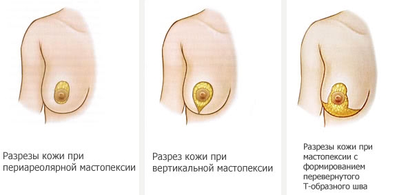 виды мастопексии
