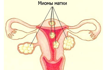 mioma_matki