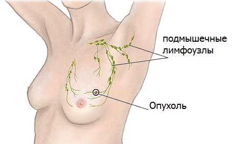 схема места образования опухолей