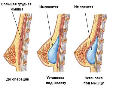 виды установки имплантов