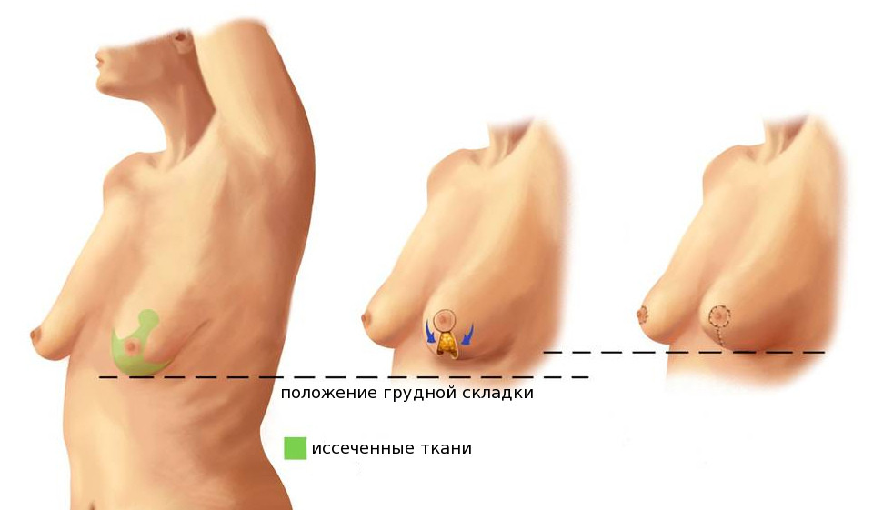 операционная подтяжка